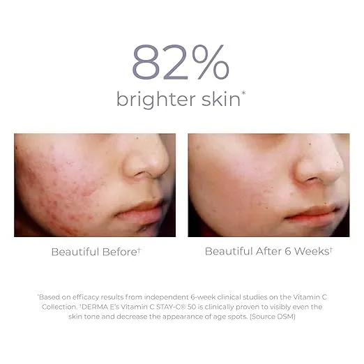 DERMA E Vitamin C 10% Multi-Acid Radiance Liquid Peel – Exfoliating and Brightening Skin Care Treatment with Niacinamide, Lactic Acid and Bromelain – For Uneven Tone and Discoloration, 1 Fl Oz